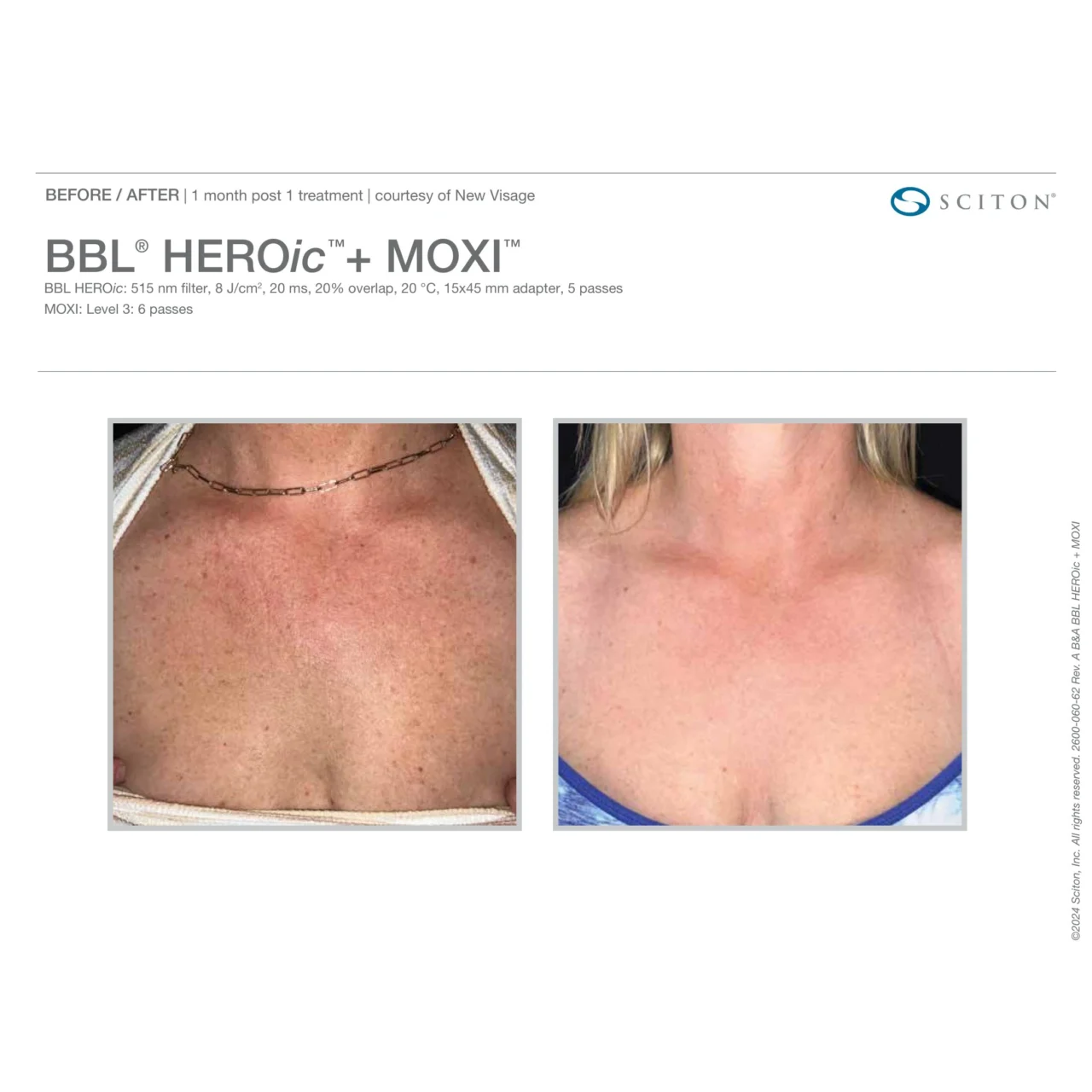 Before and after photos showing reduction in redness and sun damage on the chest and décolletage 1 month after one BBL HEROic + MOXI treatment
