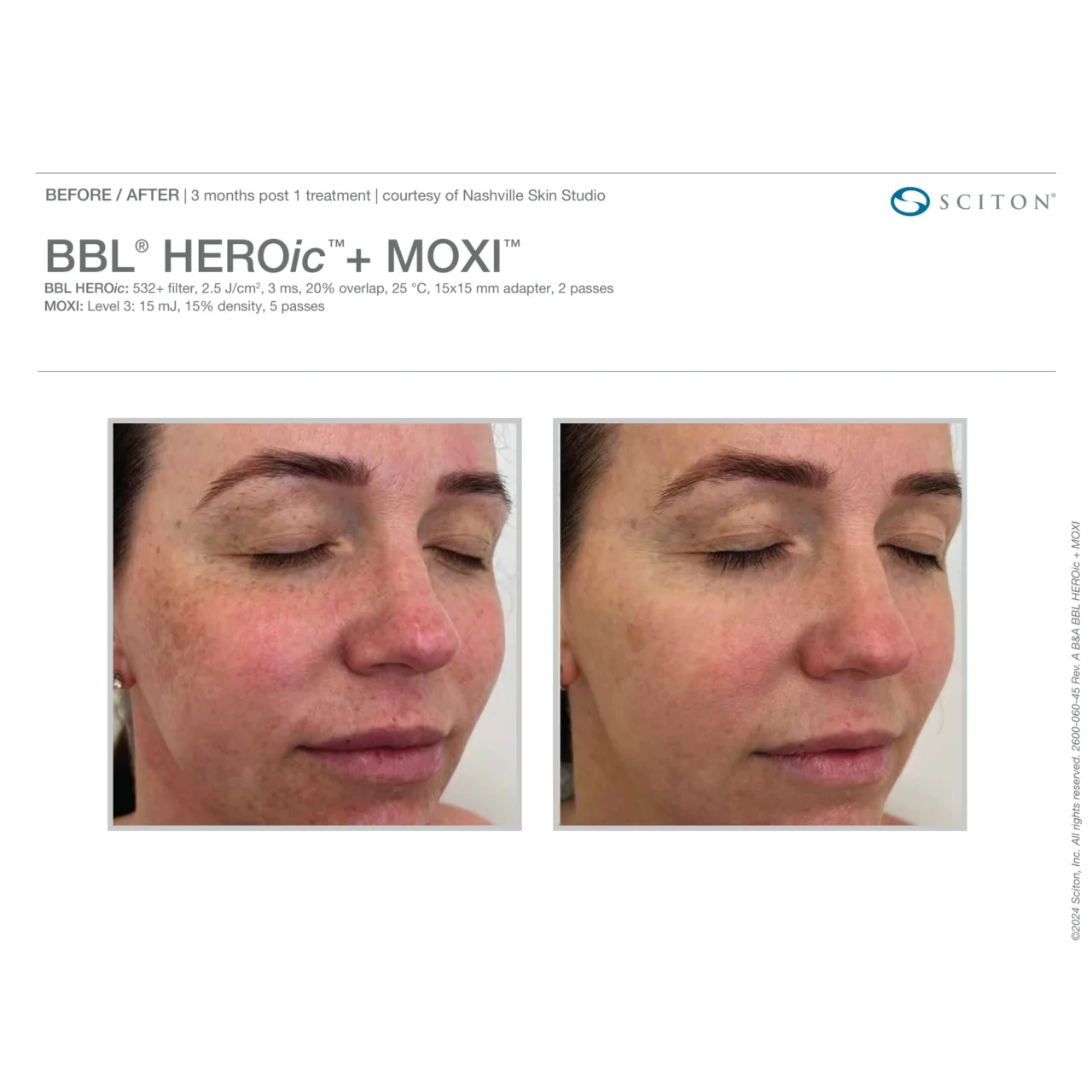 Before and after photos showing reduction in facial pigmentation and sun spots 3 months after one BBL HEROic + MOXI treatment