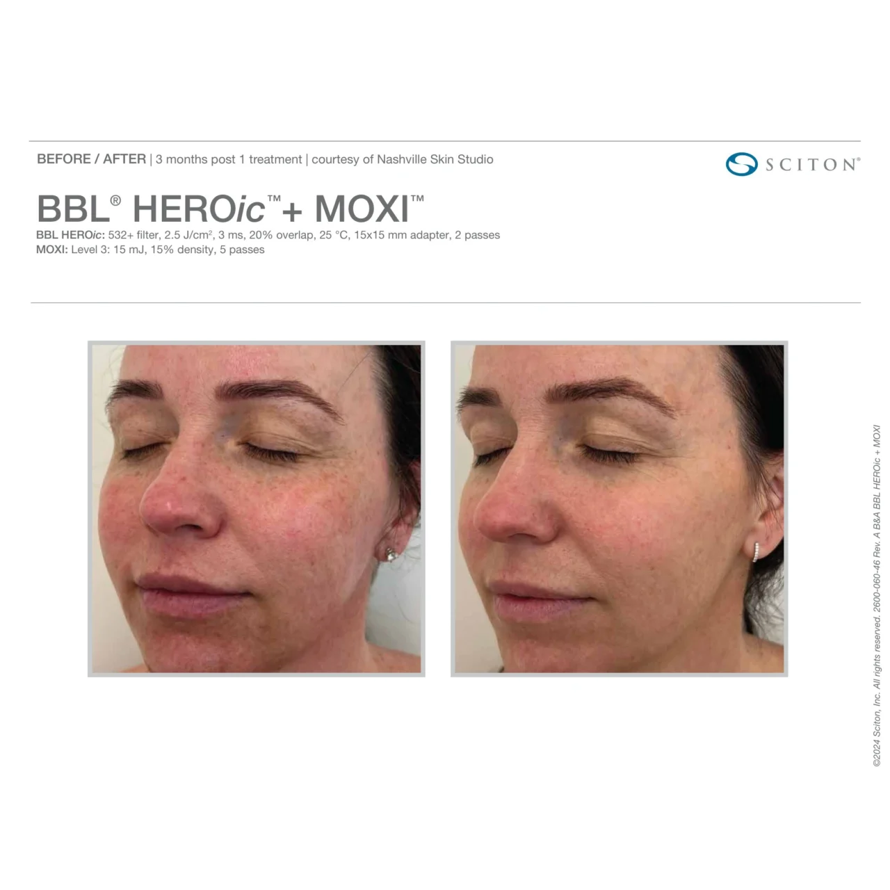 Before and after photos showing improvement in facial redness and skin tone 3 months after one BBL HEROic + MOXI treatment