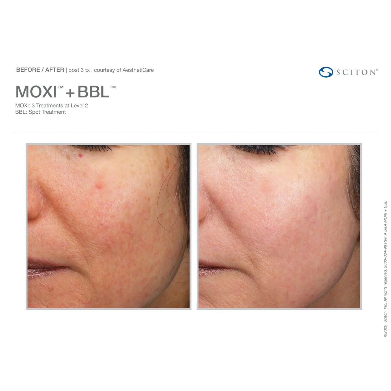 Before and after close-up photos showing improvement in acne, skin texture, and tone after 3 MOXI + BBL treatments