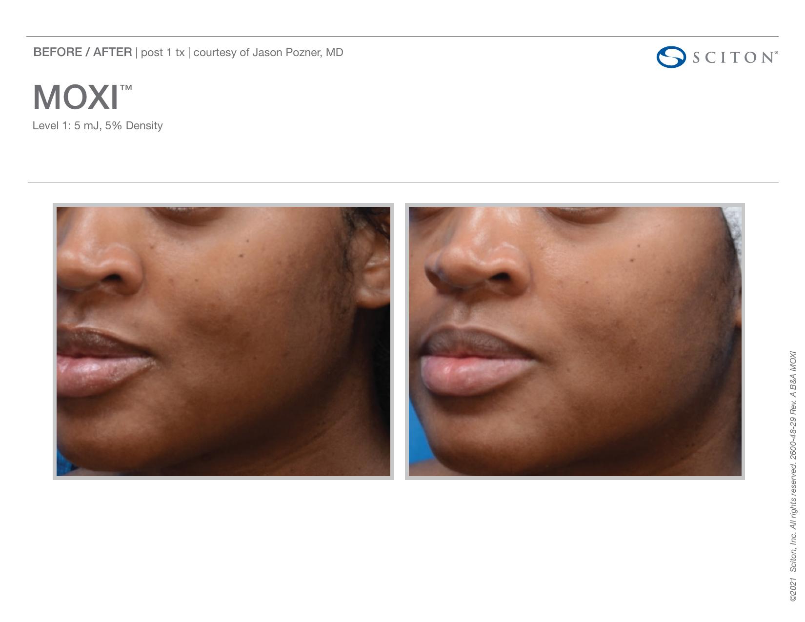 Before and after angled photos showing reduction in facial pigmentation after one MOXI treatment, courtesy of Jason Pozner MD.