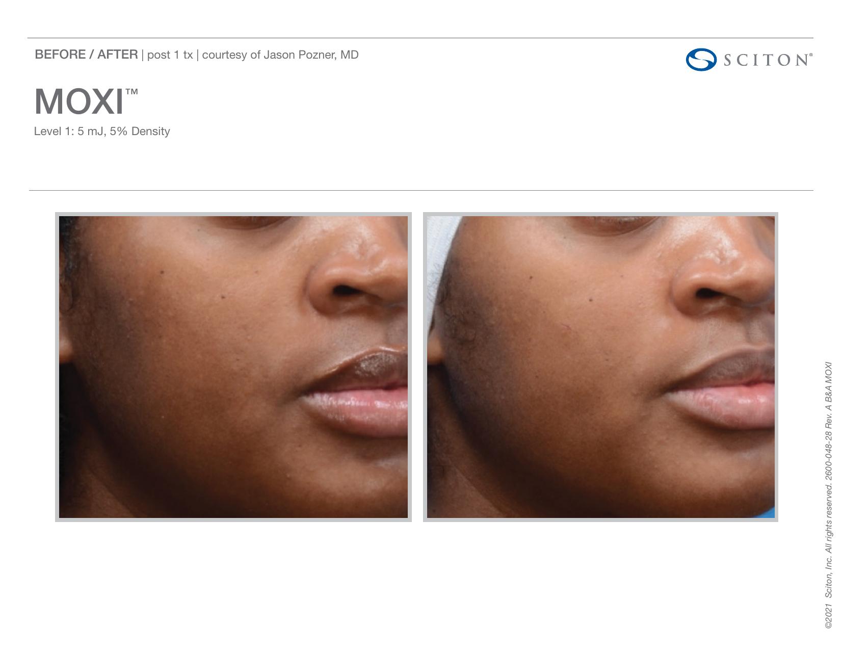 Before and after angled close-up photos showing improvement in skin pigmentation after one MOXI treatment, courtesy of Jason Pozner MD.