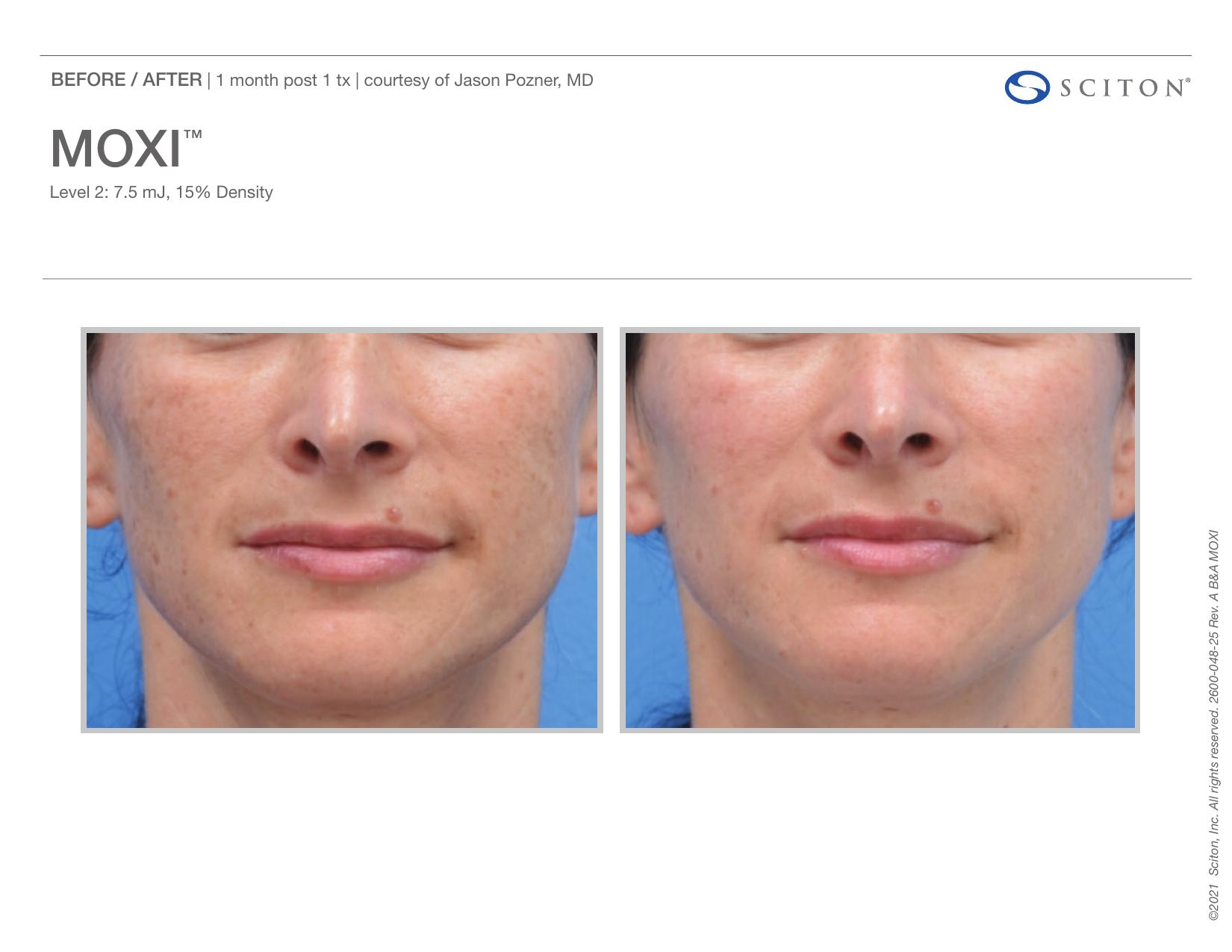 Before and after front-facing photos showing reduction in facial pigmentation 1 month after one MOXI treatment, courtesy of Jason Pozner MD.