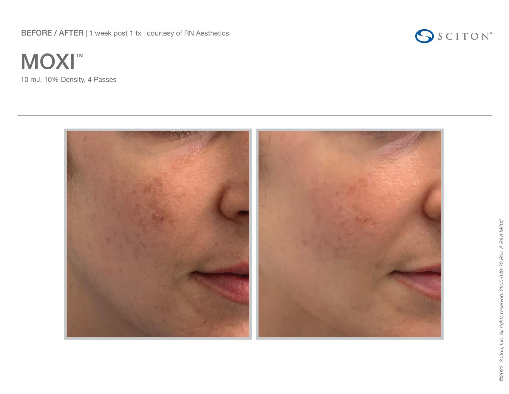 Before and after angled photos showing improvement in facial pigmentation and skin.