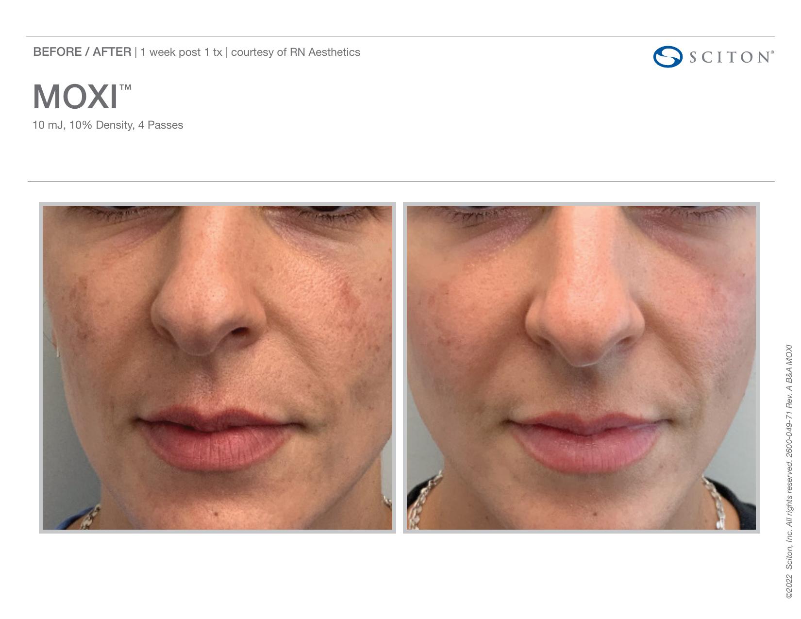 Before and after front-facing photos showing reduction in facial pigmentation 1 week after one MOXI treatment, courtesy of RN Aesthetics.