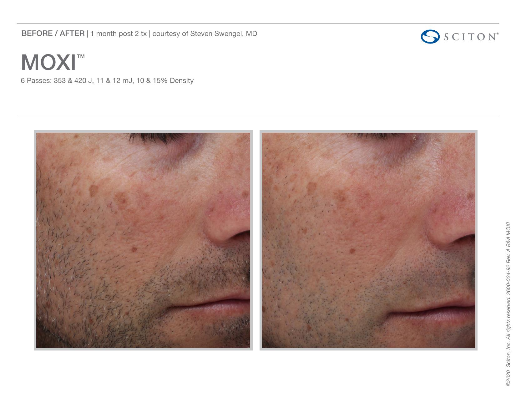Before and after angled photos showing reduction in facial pigmentation and sun damage on a male patient 1 month after 2 MOXI treatments, courtesy of Steven Swengel MD.