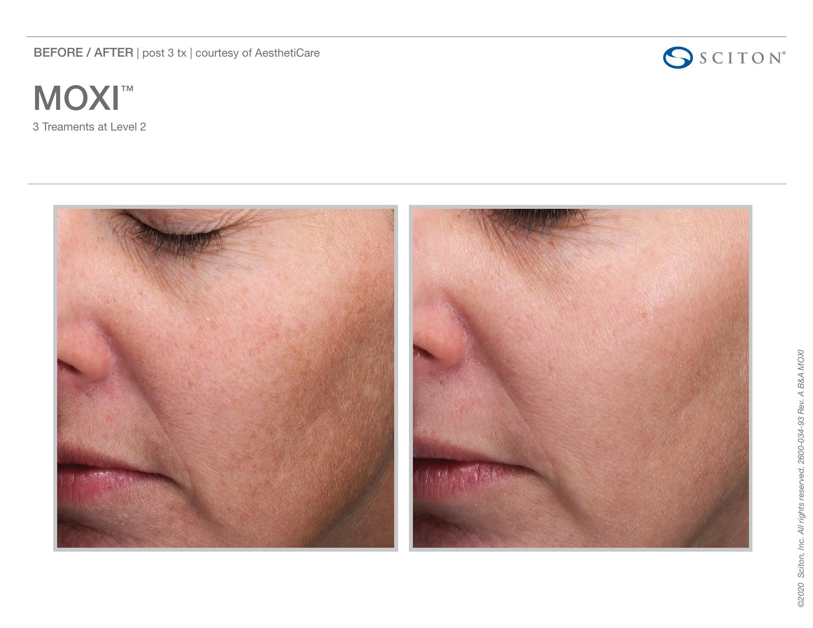 Before and after angled close-up photos showing reduction in facial redness and pigmentation after 3 MOXI treatments, courtesy of AesthetiCare.