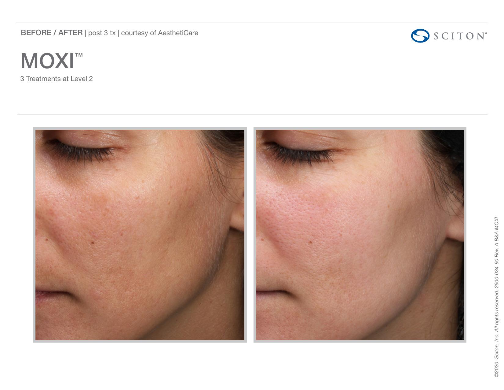 Before and after close-up photos showing improvement in cheek redness and skin tone after 3 MOXI treatments, courtesy of AesthetiCare.
