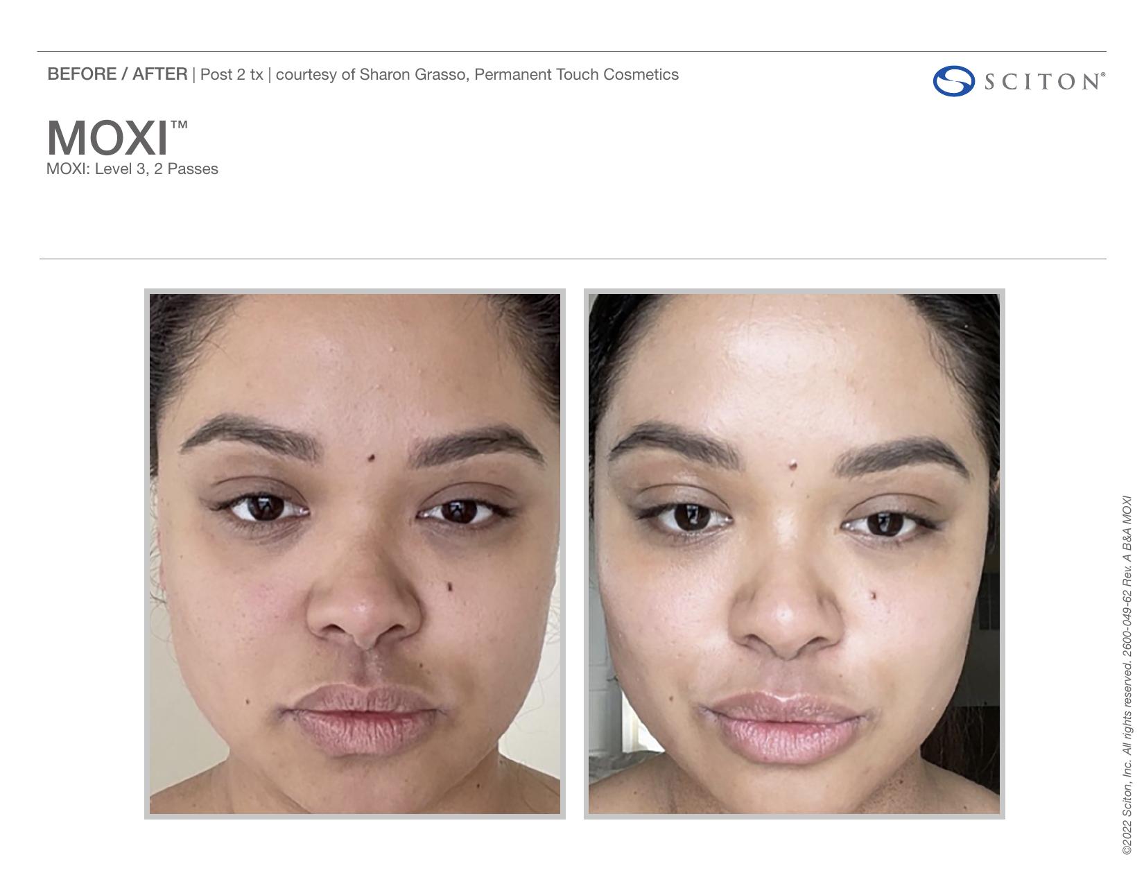 Before and after front-facing photos showing improved skin tone and clarity after 2 MOXI treatments, courtesy of Permanent Touch Cosmetics.