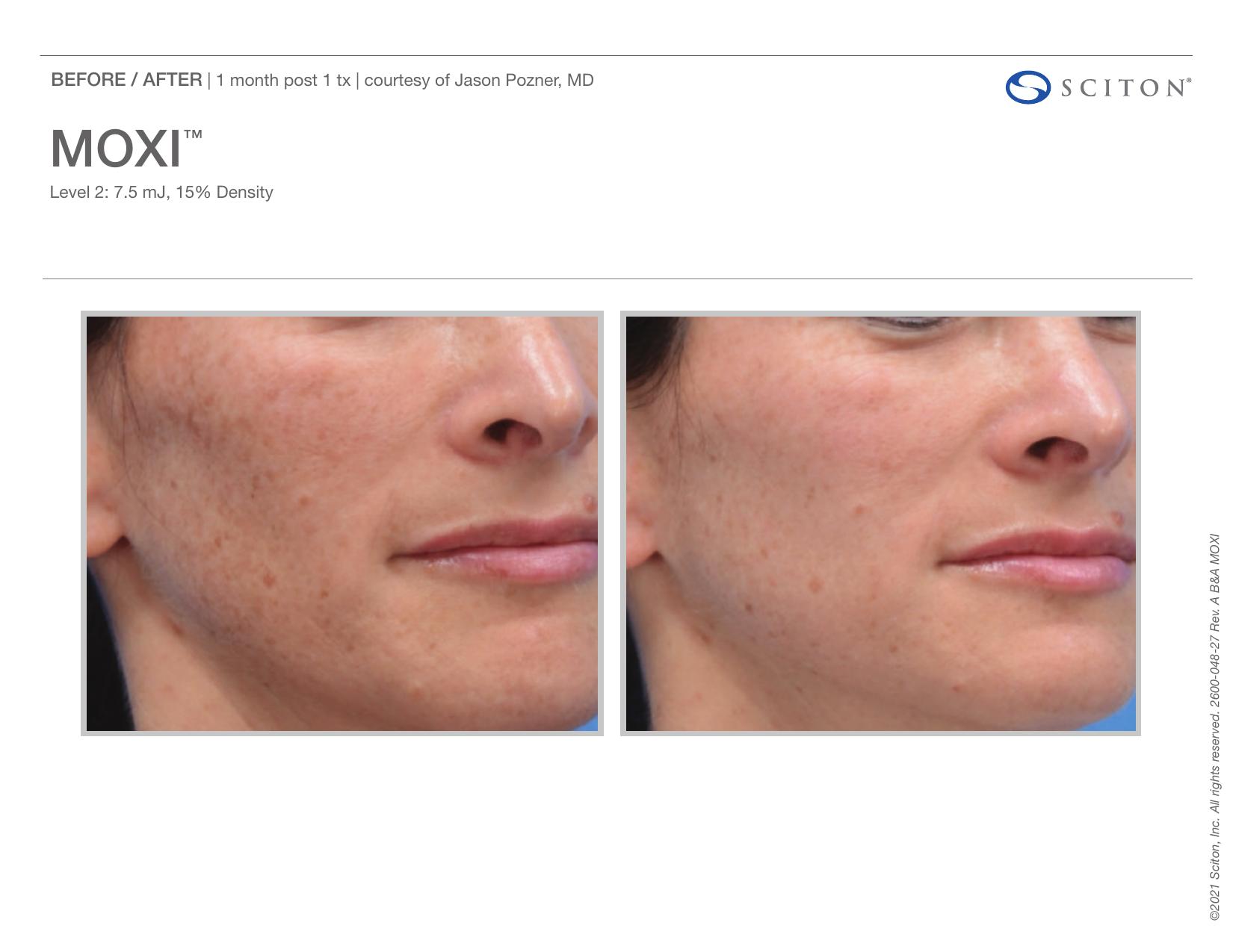 Before and after close-up photos showing improvement in cheek sun spots and skin texture 1 month after one MOXI treatment, courtesy of Jason Pozner MD.