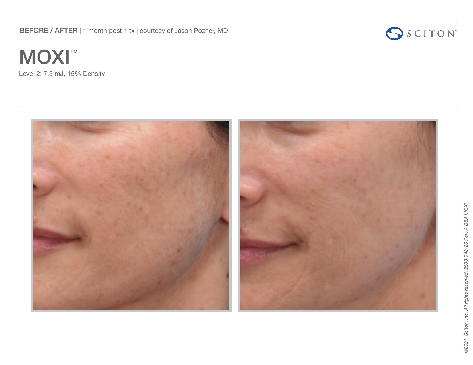 Before and after close-up photos showing improvement in cheek sun spots and skin texture 1 month after one MOXI treatment, courtesy of Jason Pozner MD.