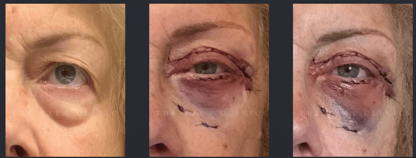 Three-panel image showing a patient's eye before blepharoplasty, immediately post-surgery with sutures, and shortly after surgery with bruising and swelling, courtesy of The Ezra Clinic