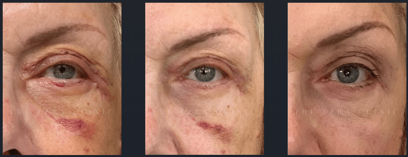 Three-panel image showing blepharoplasty healing progression from post-surgery with sutures and swelling to a more healed appearance, courtesy of The Ezra Clinic