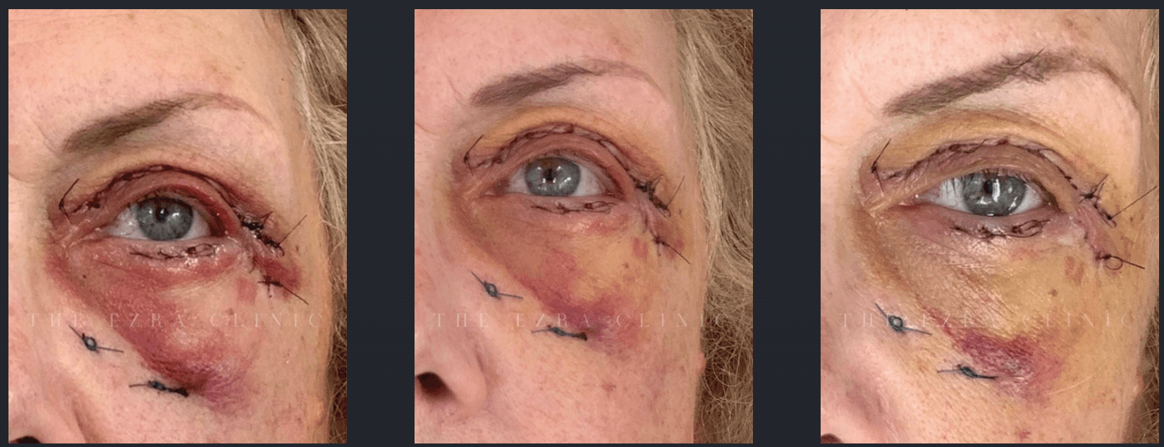 Three-panel image showing different stages of blepharoplasty recovery with sutures, bruising, and swelling around the eye, courtesy of The Ezra Clinic