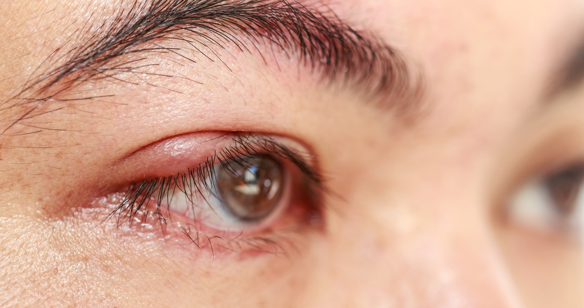 Close-up of an eye with a red, swollen upper eyelid indicating inflammation or a stye