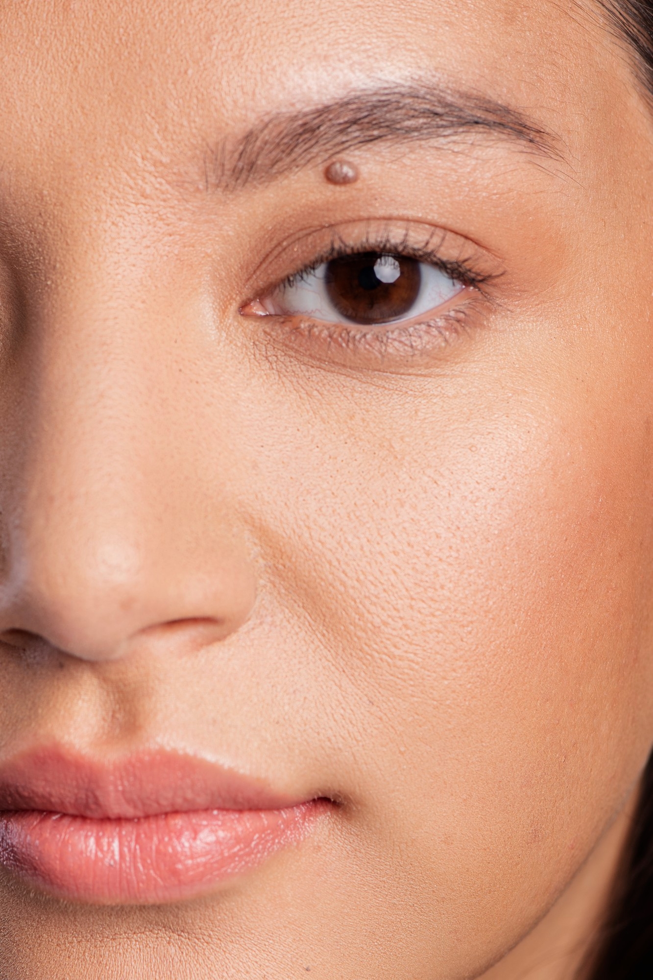 Close-up of a woman's eye and cheek showing a small skin tag on the forehead