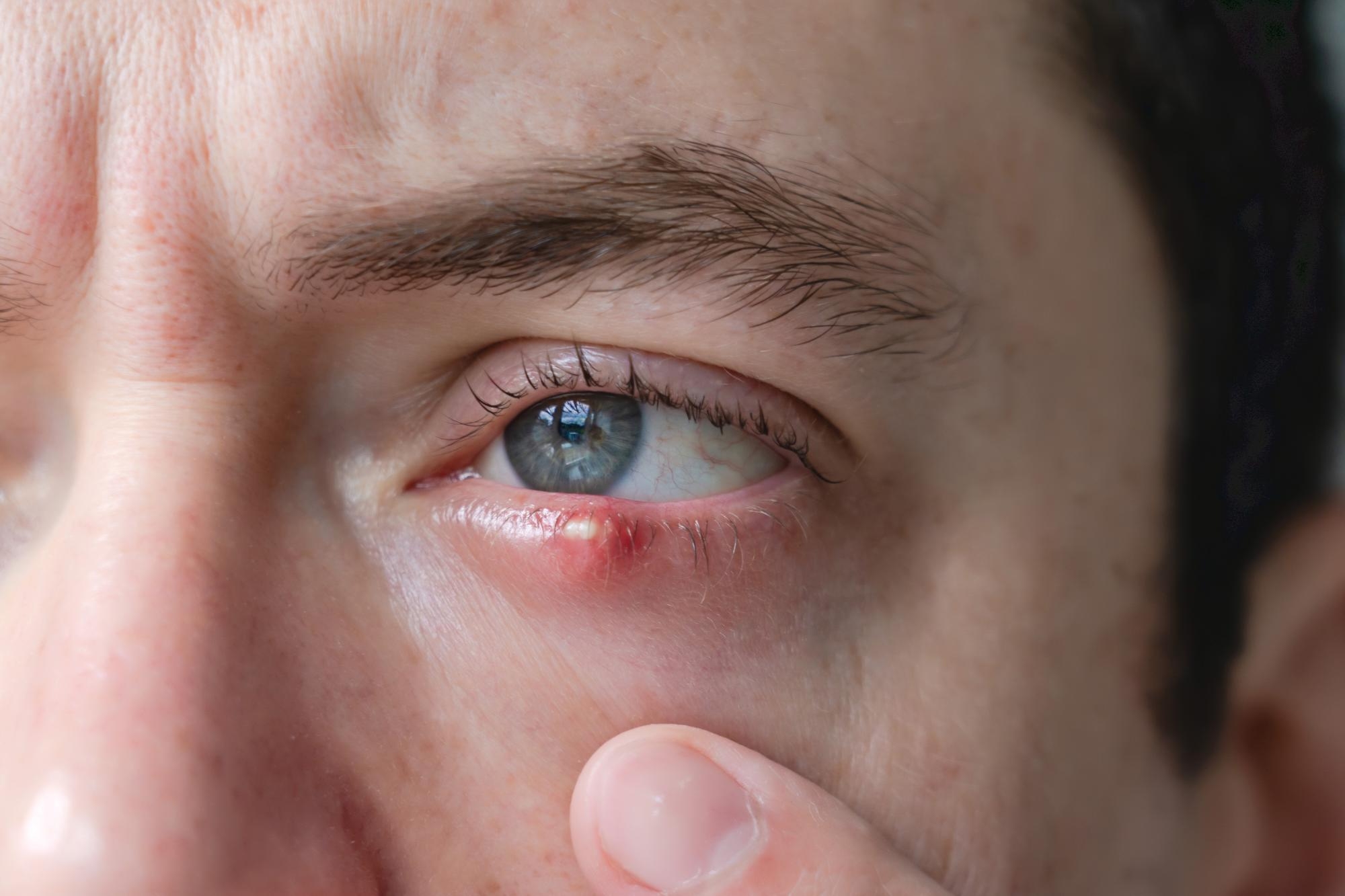 Close-up of a man's eye showing a red stye on the lower eyelid